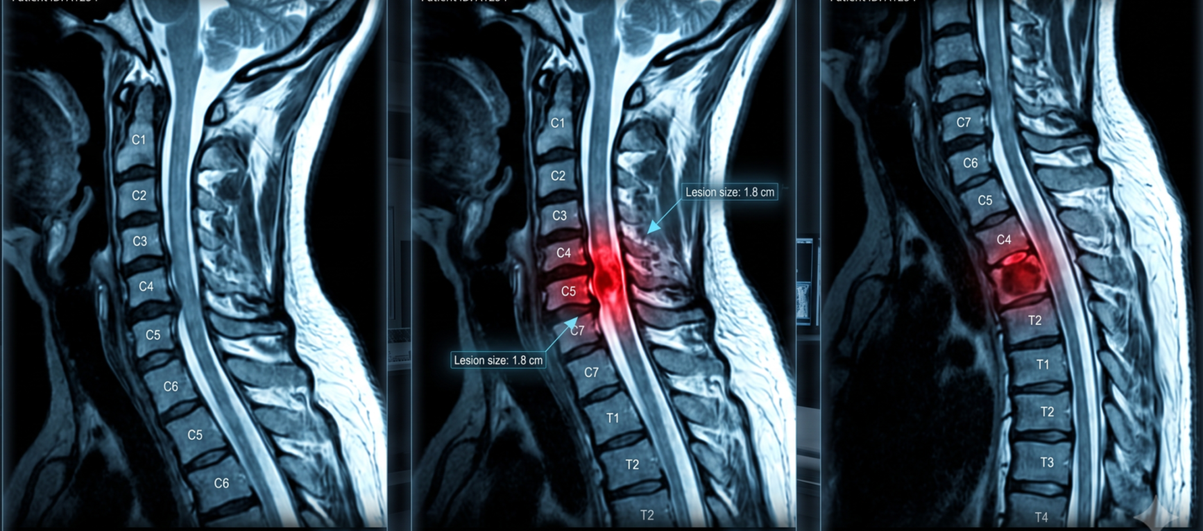 Radiofrequency ablation of a spinal tumor
